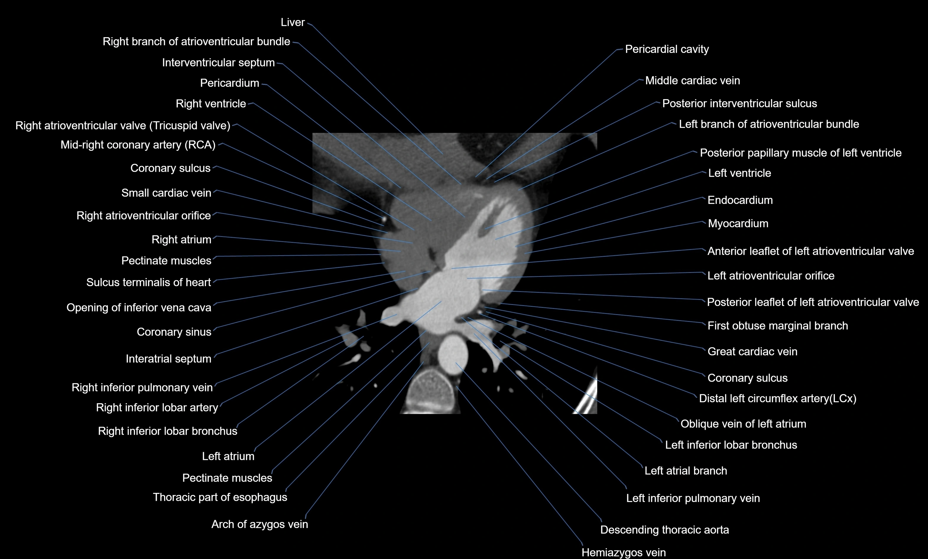 CT heart (coronary angiogram) four chamber view  cross sectional anatomy labelled radiology image -00034.webp